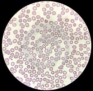 Blood film microscopic show decrease platelets leucocyte (WBC).