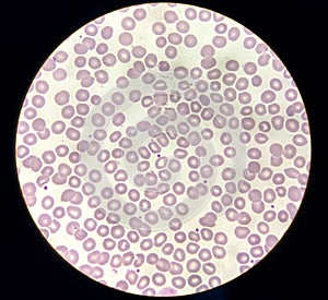 Blood film microscopic show decrease platelets leucocyte (WBC).