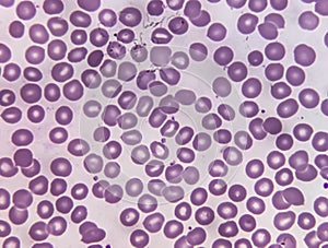 Blood film microscopic show decrease platelets leucocyte (WBC).