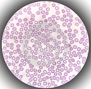 Blood film microscopic show decrease platelets leucocyte (WBC).