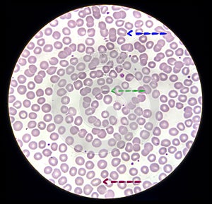 Blood film microscopic show decrease platelets leucocyte (WBC). photo