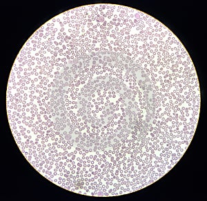 Blood film showing a decrease of platelets and White blood cells. Immune thrombocytopenic purpura (ITP)