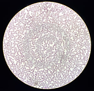 Blood film showing a decrease of platelets and White blood cells. Immune thrombocytopenic purpura (ITP) photo