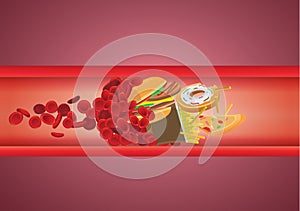 Blood flow blocked from fast food which have high fat and cholesterol.