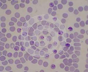 Blood parasite infected red blood cells Malaria