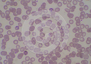Blood parasite infection red blood cells malaria