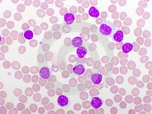 Blood picture of chronic lymphocytic leukemia