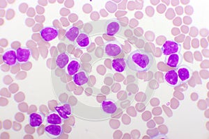 Blood picture of chronic lymphocytic leukemia