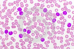 Blood picture of chronic lymphocytic leukemia or CLL