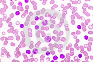 Blood picture of chronic lymphocytic leukemia or CLL