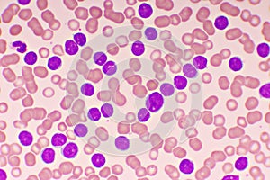 Blood picture of chronic lymphocytic leukemia or CLL