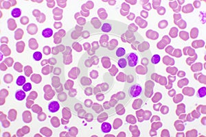 Blood picture of chronic lymphocytic leukemia or CLL