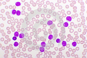 Blood picture of chronic lymphocytic leukemia or CLL