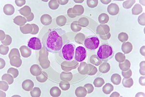 Blood smear of chronic lymphocytic leukemia