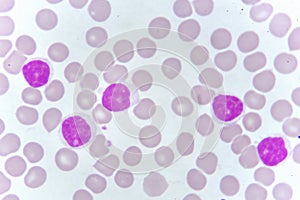 Blood smear of chronic lymphocytic leukemia