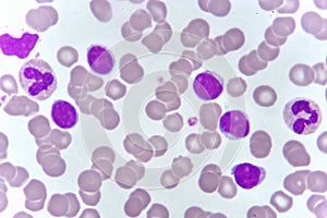 Blood smear of chronic lymphocytic leukemia