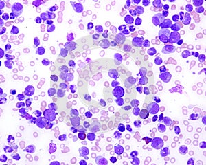 Blood smear. Chronic myeloid leukaemia