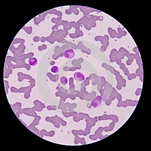 Blood smear form sepsis.