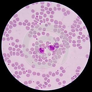 Blood smear form sepsis.