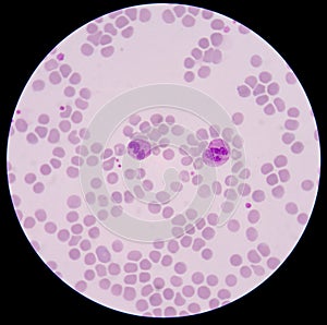 Blood smear form sepsis. photo