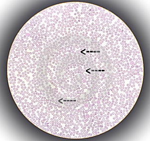Blood smear leishman stained Microscopic anemia.
