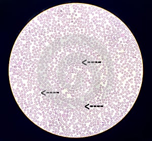 Hereditary haemolytic anemia also called Thalassemia and thrombocytopenia. photo