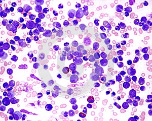 Blood smear. Leukemia photo