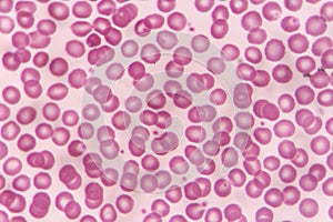 Blood smear
