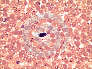 Blood smear of a patient with malaria Plasmodium falciparum