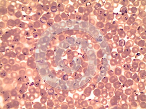 Blood smear of a patient with malaria Plasmodium falciparum - under the microscope photo