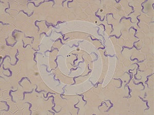 Blood smear of a patient with sleeping sickness. Trypanosoma brucei