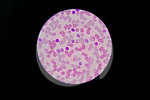 Blood smear showing chronic lymphoblastic leukemia (CLL) photo