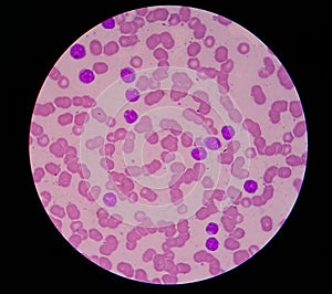 Blood smear showing chronic lymphoblastic leukemia (CLL) photo