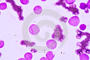 Blood smear under microscopy showing on Adult acute myeloid leukemia AML is a type of cancer in which the bone marrow makes abn photo