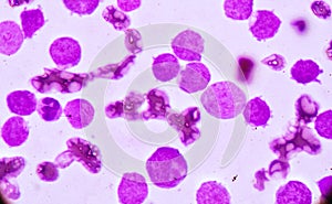 Blood smear under microscopy showing on Adult acute myeloid leukemia AML is a type of cancer in which the bone marrow makes abn photo