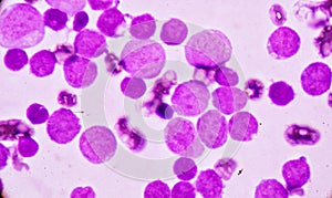 Blood smear under microscopy showing on Adult acute myeloid leukemia AML is a type of cancer in which the bone marrow makes abn