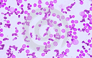 Blood smear under microscopy showing on Adult acute myeloid leukemia AML is a type of cancer in which the bone marrow makes abn photo