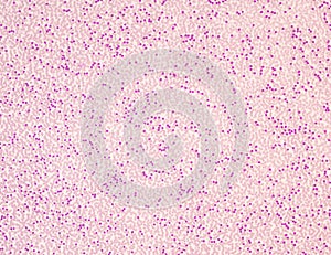 Blood smeartof acute myeloid leukemia.