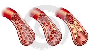 Blood stream in healthy artery and beginning arteriosclerosis, 3D illustration photo