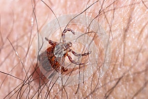 Blood-sucking mite on a human skin macro