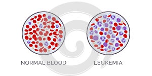 Blood test comparison: normal and leukemia