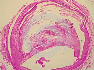 Blood vessel with arteriosclerosis