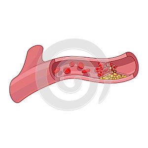 Blood vessel and clot thrombus vector illustration