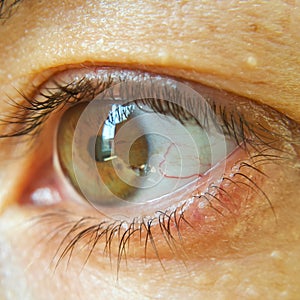 Blood vessel on the eyeball. Intraocular pressure. Bloodshot eyes. Close-up macro photography. Bleeding damage to the eye