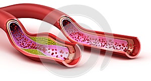 Blood vessel : normal and cholesterol damaged vessel
