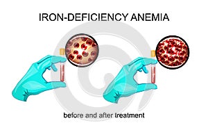Blood in vitro. red blood cells for iron deficiency anemia photo