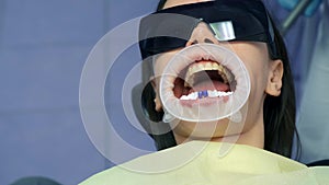 Blue acid on woman's teeth before installing veneers, prosthodontics concept.