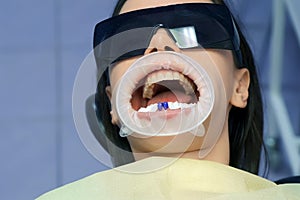 Blue acid on woman& x27;s teeth before installing veneers, prosthodontics concept.