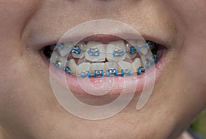 Blue Braces