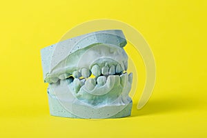 Blue cast of a dental jaw on a yellow background, close-up. Concept of taking dental impressions for making crowns for